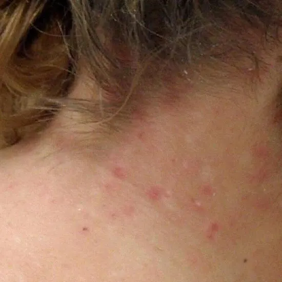 Pediculosis Capitis (Head Lice)